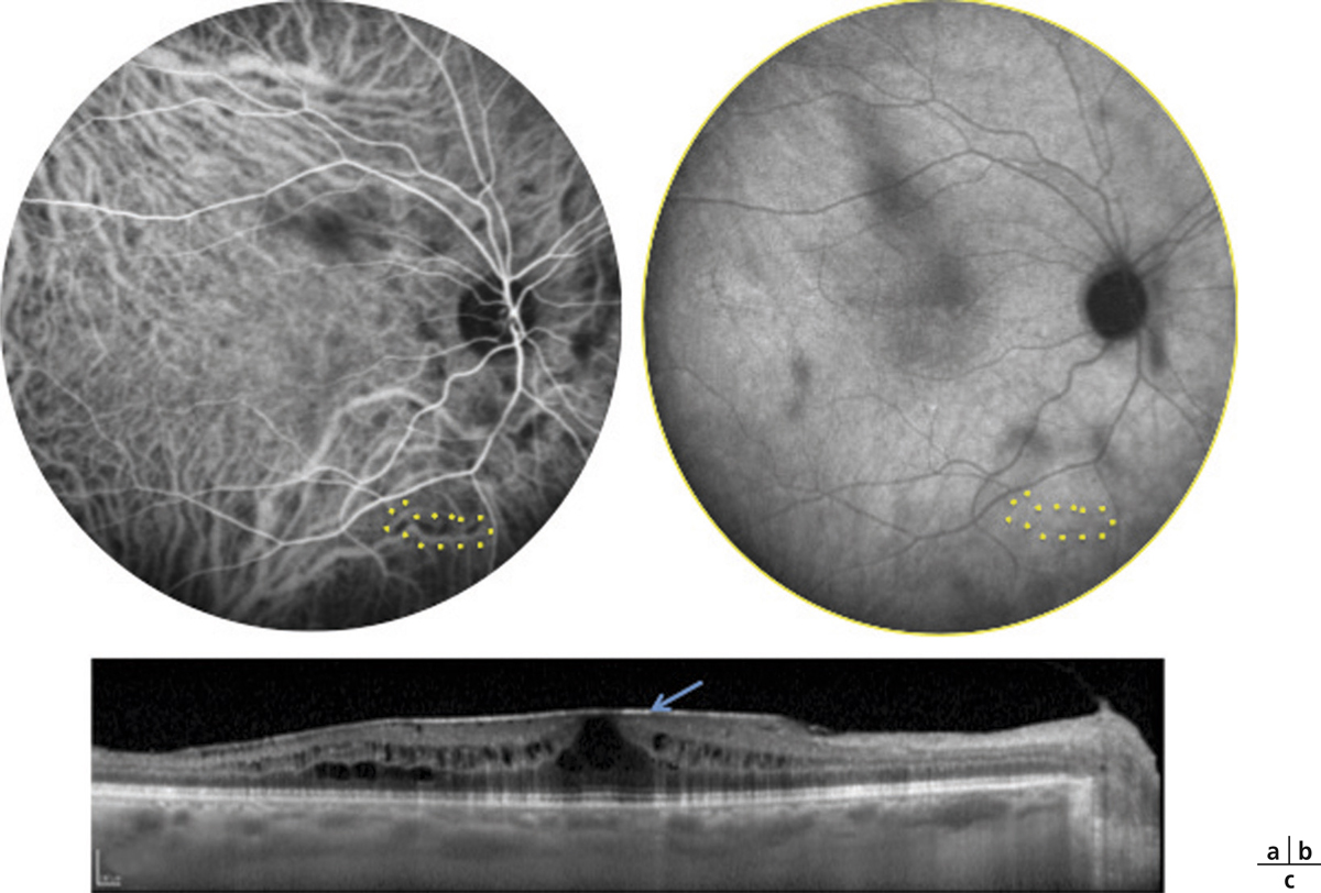 Angiographie fluorescéinique qui révèle des fuites de fluorescéine