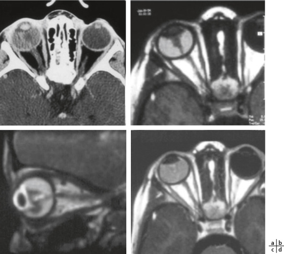 Rapport Sfo 17 Ophtalmologie Pediatrique