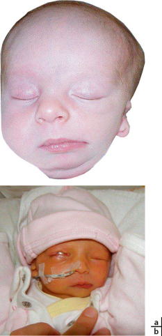 syndrome de Crouzon avant et après