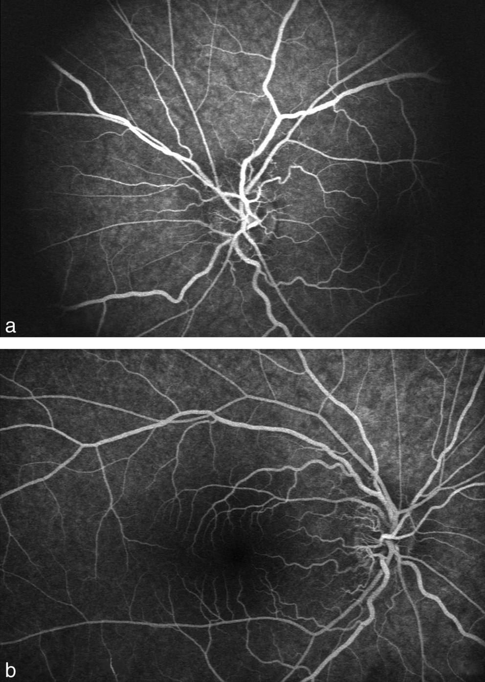 Angiographie fluorescéinique qui révèle des fuites de fluorescéine